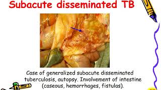 Disseminated tuberculosis [upl. by Elena56]