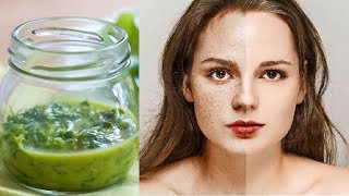 Get Rid of Freckles And Brown Spots By Using This Amazing Natural Remedy [upl. by Yoshi]