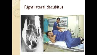 Barium Enema procedure and patterns [upl. by Alejandra]