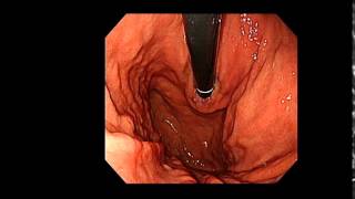 Esophagogastroduodenoscopy demonstration [upl. by Latsyrk]