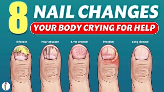 Nail signs of Disease  Nail pitting  Finger clubbing  Signs of anemia  Terrys nails [upl. by Karlen191]