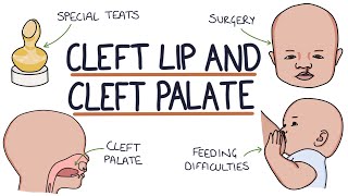 Cleft Lip and Cleft Palate For Students [upl. by Ananna]