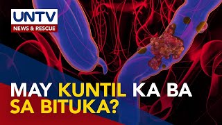 Pagkakaroon ng kuntil o polyps sa bituka posibleng mauwi sa colon cancer – expert [upl. by Jarlen218]