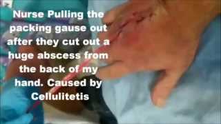 Removing Gauze from Abscess Hand Surgery abscess [upl. by Teillo]