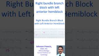 Right bundle branch block with left anterior hemiblock [upl. by Deenya]