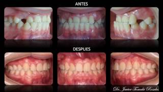 Ortodoncia antes y después mordida cruzada anterior Dr Javier Tomalá Rosales [upl. by Behah]