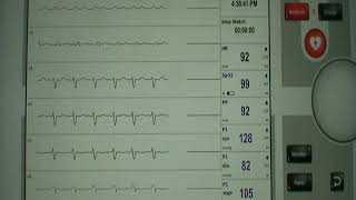 32Left anterior hemiblock [upl. by Anelrad]