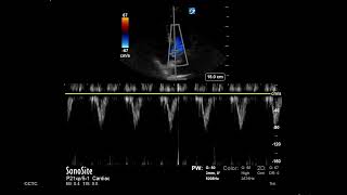 How to Measure LVOT VTI [upl. by Lomax]