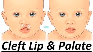 Causes of Cleft Lip amp Palate by Prof John Mew [upl. by Sandy]