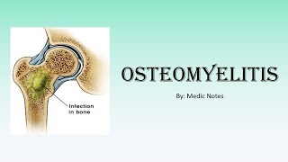 Ortho Osteomyelitis  acute hematogenous subacute hematogenous posttraumatic chronic OM [upl. by Sikko]