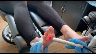 Laser Verruca Treatment Session 2  Birmingham UK [upl. by Eckblad]