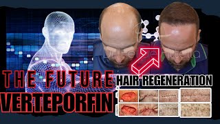 Dr Felipe Pittella Will Start A Verteporfin Trial  Possible Hair Loss Cure [upl. by Sito]