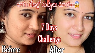 7 Days Challenge  Remove Pimple Marks amp Acne Scars Naturally at Home  మొటిమలు మచ్చలు తగ్గాలంటే [upl. by Ayoral]