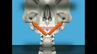 Threedimensional video zygomatic implant [upl. by Ettesus314]