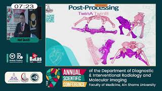 Post processing techniques in the preoperative management of conjoined twins [upl. by Suiravad196]