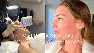 My PRP microneedling experience  Unboxing new YouTube lighting  Melbourne Vlog [upl. by Forcier112]