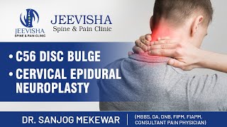 Neck pain  One Minute Video of Cervical Epidural Neuroplasty [upl. by Nnaeirual]