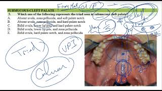 Submucous Cleft Palate [upl. by Laing]