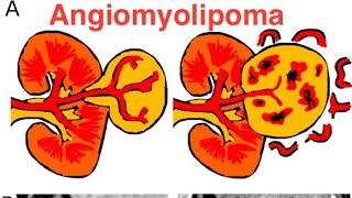 Angiomyolipoma [upl. by Gonzales]