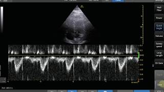 Pulse Wave Doppler Step by Step  LVOT VTI Example [upl. by Dorothee]