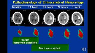 Evidence based management of intracerebral hemorrhage An update [upl. by Mintz]