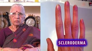 Scleroderma Treatment  DrPS Lalitha  Drugless Therapy  Reiki Treatment [upl. by Noitsuj]