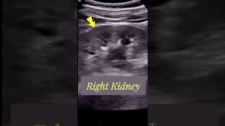 Tracing the Large  Obstructed Ureteric stone  Ultrasound [upl. by Leihcar129]