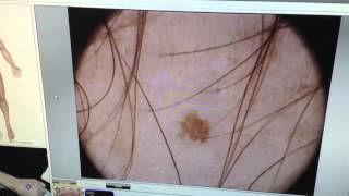 microfinder  microderm dermoscopy  diagnosis [upl. by Alehs190]