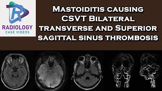 Mastoiditis causing CSVT Bilateral transverse and Superior sagittal sinus thrombosis [upl. by Neille]