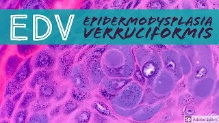 Epidermodysplasia verruciformis EDV 101 [upl. by Nylaroc]