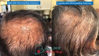 Secret RF Microneedling with PRP to add volume to hairNaz Keshwani MD [upl. by Petulia]