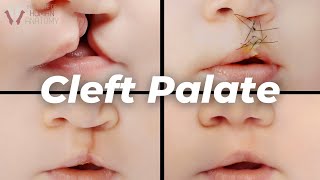 Why Cleft Palates Occur A Scientific Explanation [upl. by Vijar803]