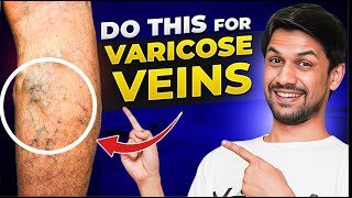 VARICOSE VEINS explained under 10 minutes  Saurabh Bothra Yoga [upl. by Yesnel]