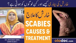 KHARISH KA ILAJ  Scabies Treatment In Urdu  Kharish Ki Bimari Kyun Hoti Hai  Itching Solution [upl. by Rramed]