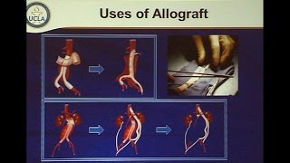 Aortic Graft Infection Contemporary Management of a Resurgent Problem  Binkley Lecture [upl. by Auqenet]