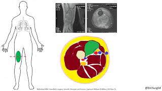 Soft Tissue Sarcoma [upl. by Lorenz]