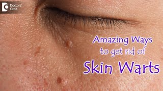 AMAZING WAYS TO GET RID OF SKIN WARTS  Skin Wart Removal Tips  DrNischal K  Doctors Circle [upl. by Fishman891]