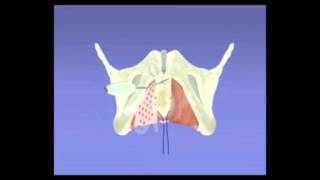 PROLAPSOS GENITAIS  Cirurgia de Prolapso com Tela Calistar [upl. by Kerwinn71]