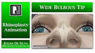 Rhinoplasty animation  How can a Large and Wide Bulbous Tip be made smaller [upl. by Haral]