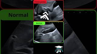 Incipient Cholecystitis Ultrasound Findings [upl. by Ennirak]