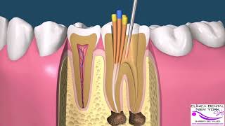 ENDODONCIA MANUAL POSTE COMPO CORONA [upl. by Layman]