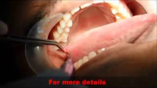 Video Excision of FIBROMA in tongue with ZOLAR laser [upl. by Brenza]