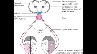 Damage to the ipsilateral motor cortex leading to weakness of risorius muscle of contralateral side [upl. by Tratner]