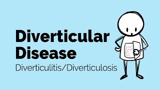 Diverticular Disease  Diverticulitis  Gastrointestinal Society [upl. by Riddle]