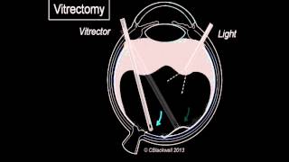 Vitreous 3 Vitrectomy Surgery [upl. by Tibold]