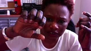 MON COMBAT CONTRE LES PHALANGES NOIRE AVEC DERMOPHIL EXPERT [upl. by Giralda]