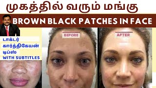 மங்கு மறைய டிப்ஸ்Home remedies to remove brown black patches spots hyperpigmentation on face skin [upl. by Fontana]