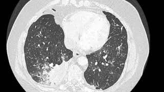 Right lower lobe pneumonia [upl. by Ilellan]