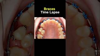 Braces time lapse Before and after transform braces orthodontist bracesoff dentist [upl. by Omari]