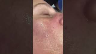 Clogged Pores amp how we unclog them  Dr Medispa [upl. by Suivat]